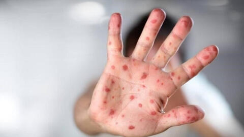 Dịch tay chân miệng tại Hà Nội đã vượt mốc 1.000 ca, khuyến cáo phụ huynh giữ vệ sinh cho con