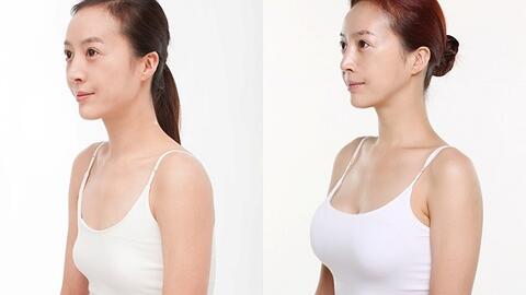 Những nguyên tắc để có một ca nâng ngực "êm ả"