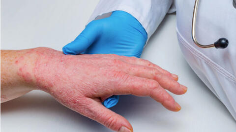 TP.HCM lên phương án giám sát bệnh đậu mùa khỉ