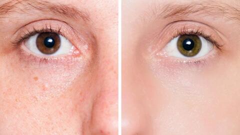 7 sai lầm khi chăm sóc da có thể khiến bạn bị mụn