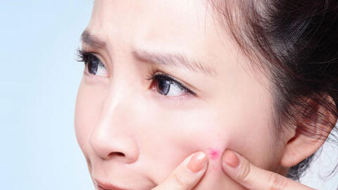 Mẹo chăm sóc da đúng cách sau khi nặn mụn