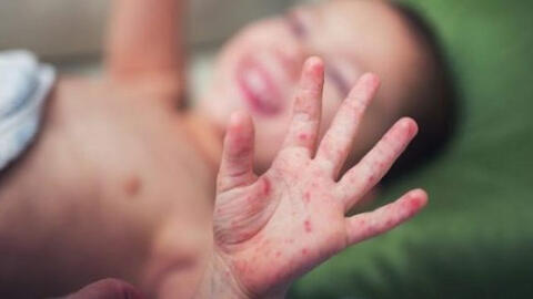 Bộ Y tế: Đã có 5.545 ca mắc tay chân miệng, 1 trường hợp tử vong, dự báo dịch có thể gia tăng