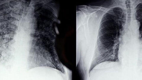 Các triệu chứng thường gặp ở những người từng mắc COVID-19