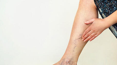 7 thói quen hàng ngày có thể làm giãn tĩnh mạch chân của bạn