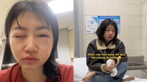 Nữ ca sĩ bị dị ứng sưng húp mắt ngay trước khi diễn countdown, mới đầu năm đã gặp "kiếp nạn"!