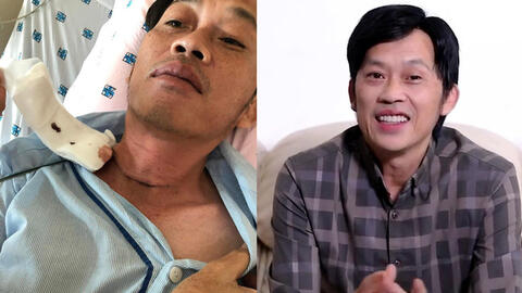 Nghệ sĩ Hoài Linh phẫu thuật vì bị u ác tuyến giáp cách đây vài tháng