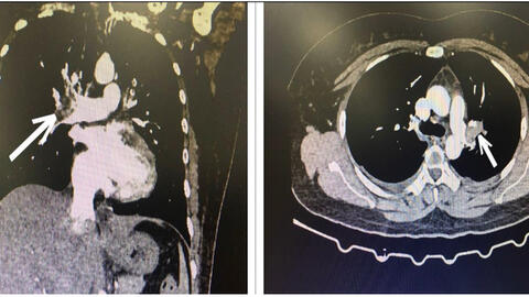Một người phụ nữ bị nhồi máu phổi vì uống 15 viên thuốc tránh thai khẩn cấp mỗi tháng