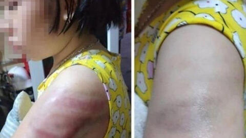 Vụ học sinh bị đánh bầm tím tay vì viết bài chậm: Cô giáo tường trình do mất bình tĩnh