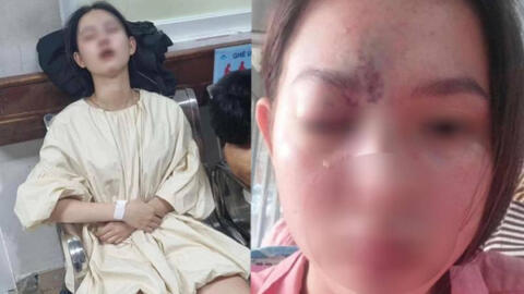 Thiếu nữ 17 tuổi mù mắt vĩnh viễn, liệt nửa não trái sau tiêm filler nâng mũi: Đừng quên 4 điều để an toàn khi làm đẹp