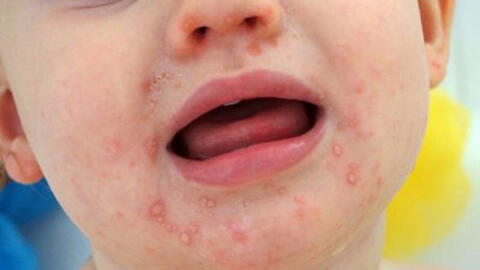 Trẻ bị tay chân miệng nhập viện tiếp tục tăng cao