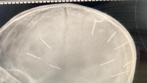 Triệu tập mẹ bé gái có 9 dị vật trong sọ não