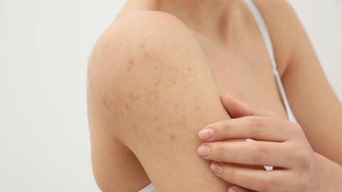 6 nguyên nhân gây ra các lớp 'da gà' sần sùi và cách khắc phục