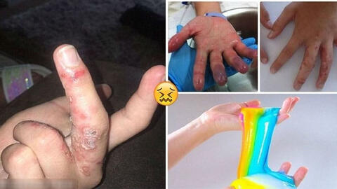 Vì sao 'chất nhờn ma quái' trẻ em khắp thế giới mê mẩn lại khiến nhiều người nhập viện cấp cứu?