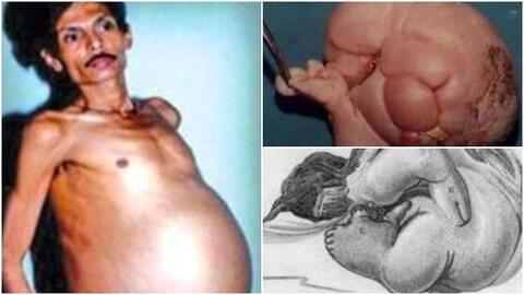 Người đàn ông mang trong mình "thai chết lưu" suốt 36 năm, bào thai nặng 4kg, có cả tóc và tay chân