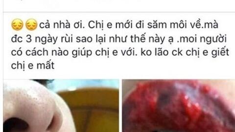 Xăm môi đón Tết, khách hàng dở khóc dở mếu với đôi môi nhiễm trùng