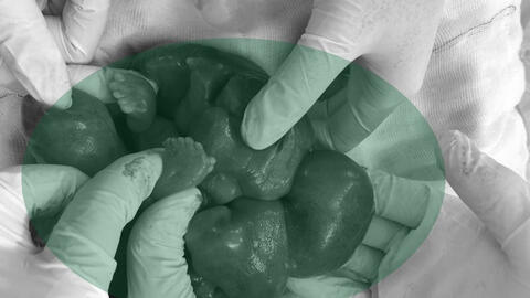 Hy hữu: Bào thai nằm trong bụng bé gái mới chào đời