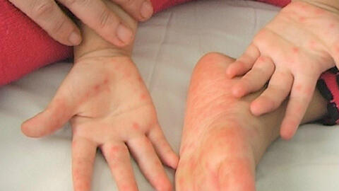 Trường mầm non che giấu việc có trẻ mắc bệnh truyền nhiễm khiến bệnh lây lan