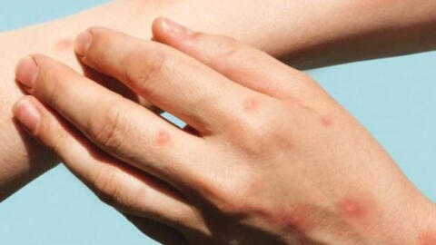 WHO: Bệnh đậu mùa khỉ không còn là tình trạng khẩn cấp y tế toàn cầu