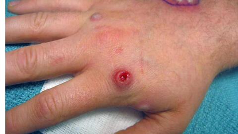 WHO thừa nhận sự lây lan "bất thường" của virus đậu mùa khỉ