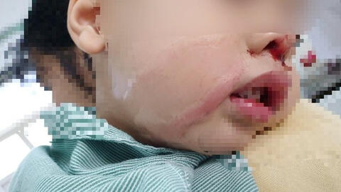 Bé trai 2 tuổi bị nhỏ nhầm axit vào mũi