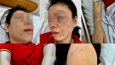 Người phụ nữ bị chồng cũ tra tấn dã man từ Hà Nội lên Hòa Bình