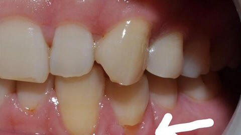 Răng vỡ rụng từng mảng vì cách đánh răng sai nhiều người mắc