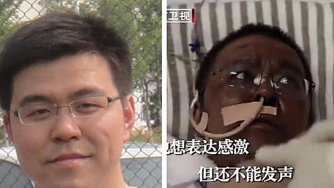 Hai bác sĩ Trung Quốc bị đổi màu da sau thời gian chống chọi với Covid-19