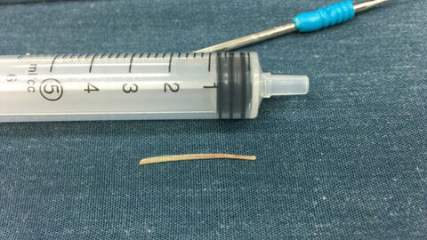 Bé gái suýt mất mạng vì hóc xương cá 5 tháng, trị bằng mẹo dân gian