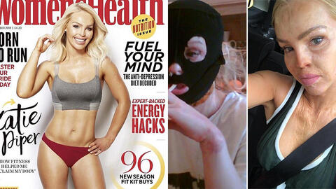 11 năm bước ra từ địa ngục của nữ người mẫu Anh bị bạn trai tạt axit