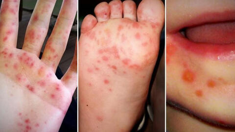 Phân bổ 6.000 chai thuốc trị tay chân miệng cho các bệnh viện