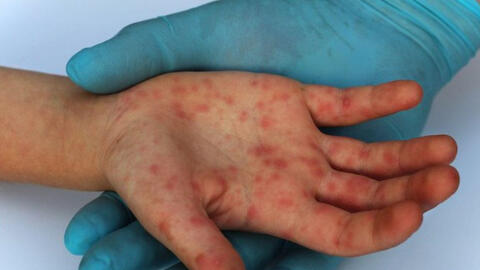 Đậu mùa khỉ được xếp vào bệnh truyền nhiễm nhóm B