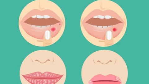4 dấu hiệu bệnh nghiêm trọng có thể xuất hiện ở môi: Nếu thấy cần đi khám ngay