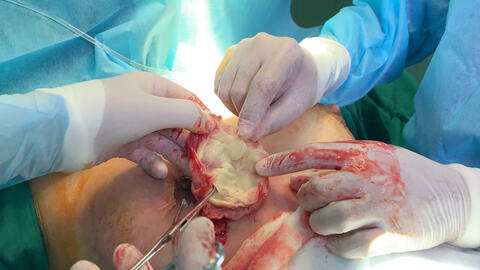 Nữ khách hàng bị bỏ quên miếng gạc khi nâng ngực tại spa