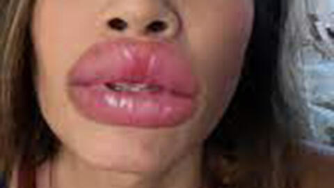 Cô gái 28 tuổi cấp cứu vì môi sưng tấy như "2 chiếc xúc xích", bác sĩ chỉ cách dưỡng môi mùa đông