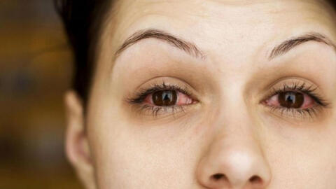 Một số bệnh nhân Covid-19 nặng gặp biến chứng nguy hiểm trên mắt có thể gây mù lòa