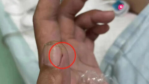 Bị viêm màng não nguy kịch vì cách sơ chế thịt lợn sai nhiều người mắc