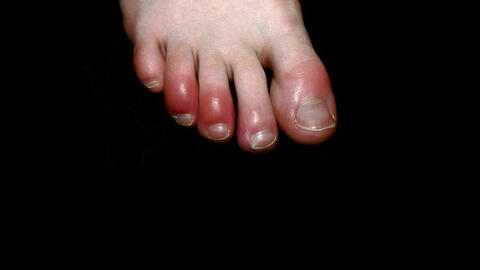 Hiện tượng "ngón chân Covid-19" tăng đột biến