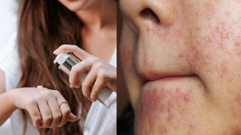 Sẽ thế nào nếu bạn lạm dụng retinol để chống lão hóa da?