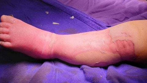 Bé trai 9 tháng tuổi tử vong vì đắp lá bà lang chữa bỏng