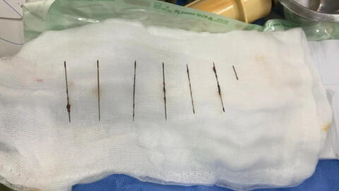 Thanh niên 28 tuổi tự đâm 7 cây kim khâu vào ngực