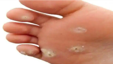 8 giải pháp tốt nhất để trị mụn cóc, bạn đã làm thử chưa?