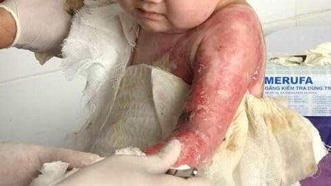 Bé 9 tháng tuổi tử vong do được 'thầy lang' đắp lá chữa vết bỏng