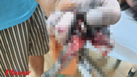 Một thiếu niên bị nổ nát cả bàn tay khi vừa sạc điện thoại vừa chơi game