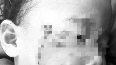 Một cháu bé 3 tuổi bị chó cắn nát mặt