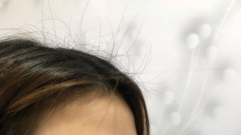 Khi phẫu thuật nâng mũi, cần phải lưu ý những gì?