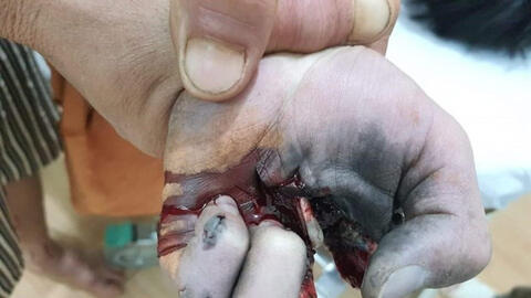 Thiếu niên bị nổ nát bàn tay do vừa sạc điện thoại vừa chơi game