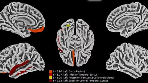 Đã tìm ra cách COVID-19 tấn công não bộ: Lối ra cho người “mắc kẹt"?