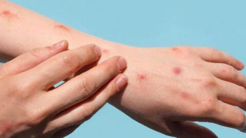 Những đối tượng nào cần tiêm chủng vaccine đậu mùa khỉ?