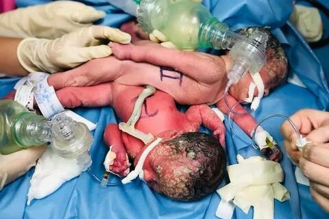 Hôm nay 15/7, hơn 100 y bác sĩ phẫu thuật tách ca song sinh dính nhau Trúc Nhi và Diệu Nhi