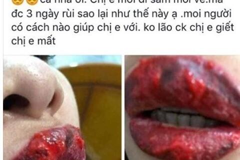 Xăm môi đón Tết, khách hàng dở khóc dở mếu với đôi môi nhiễm trùng